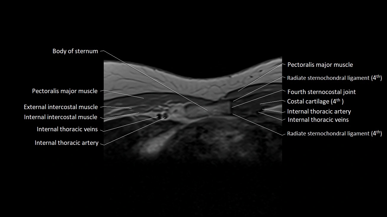 MRI sternum and sternoclavicular joint labeled axial anatomy image 23.webp